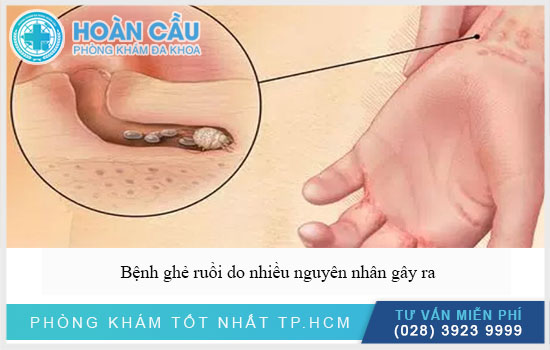 Có nhiều nguyên nhân gây bệnh ghẻ ruồi