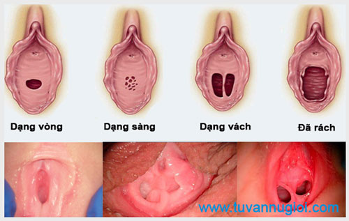 Tìm hiểu cấu tạo màng trinh con gái