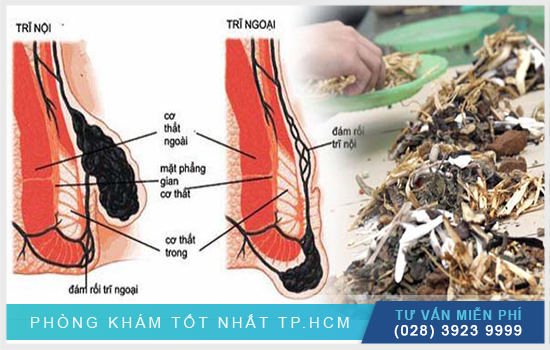 Tìm hiểu thuốc dân tộc chữa bệnh trĩ có hiệu quả hay không?