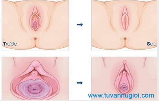 Tìm Hiểu Vị Trí Màng Trinh Và Cấu Tạo Màng Trinh Của Phụ Nữ