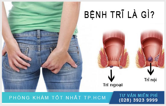 [TP.HCM] Tổng quan về bệnh trĩ - căn bệnh phổ biến nhất ở hậu môn