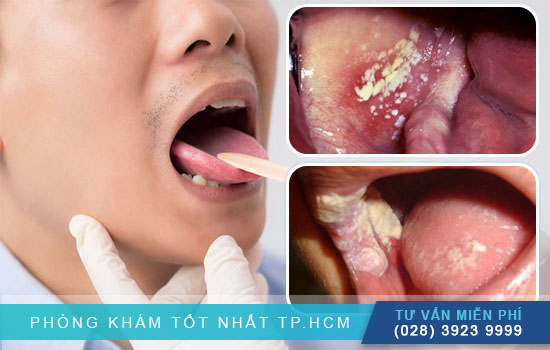 Tìm hiểu triệu chứng lậu ở miệng Trieu-chung-lau-mieng-va-nhung-dieu-can-biet