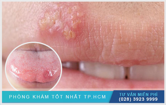 Triệu chứng herpes môi Trieu-chung-nhan-biet-nhiet-mieng-herpes-mun-rop-moi