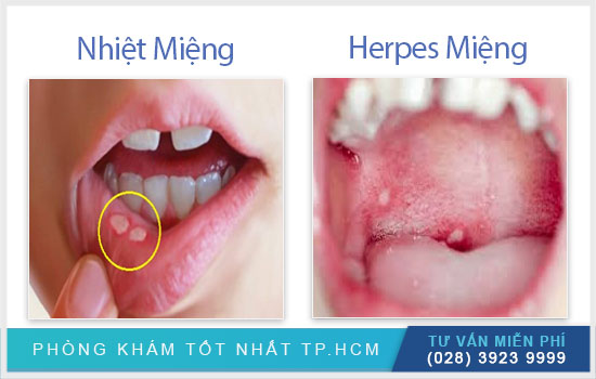 Triệu chứng herpes môi Trieu-chung-nhan-biet-nhiet-mieng-herpes-mun-rop-moi1