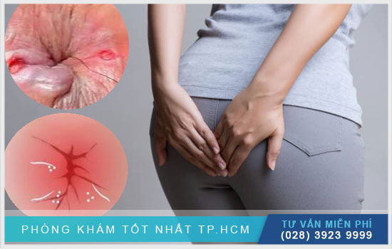 [TPHCM] Tư vấn ngứa hậu môn là bệnh gì? làm sao để hết ngứa?