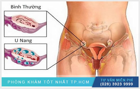 Điều cần biết khi bị u nang buồng trứng U-nang-buong-trung-phai-kieng-nhung-gi-khi-nao-can-di-kham