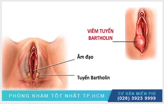 U nang tuyến bartholin: Nguyên nhân, biểu hiện và cách điều trị hiệu quả