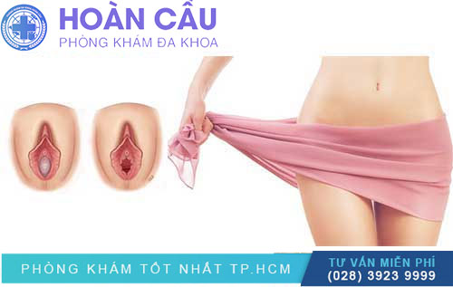 Tìm Hiểu Chi Tiết Về Thủ Thuật Và Chi Phí Vá Màn Trinh