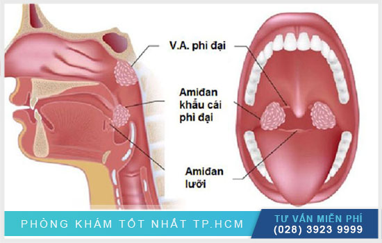 Viêm amidan lưỡi: Triệu chứng điển hình và cách điều trị hiệu quả