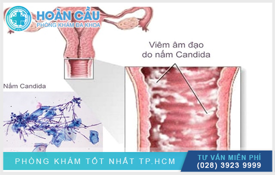 Viêm cửa mình có thể dấu hiệu của nấm Candida hoặc bị bệnh lậu