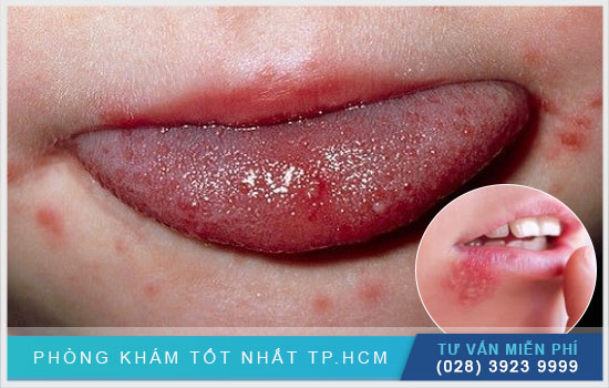 Viêm miệng do herpes: nguyên nhân, dấu hiệu và cách chữa trị [TPHCM - Bình Dương - Đồng Nai - Long An - Tiền Giang]