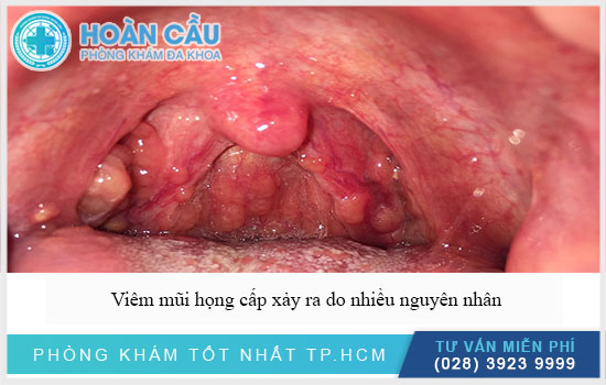 Viêm mũi họng cấp xảy ra do nhiều nguyên nhân