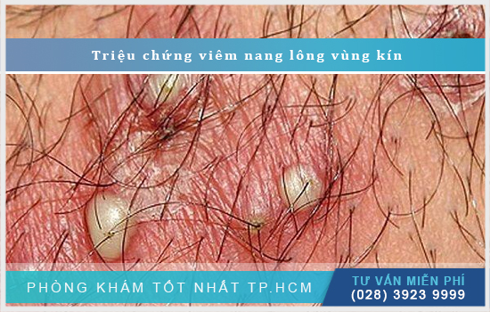 Viêm nang lông vùng kín: Nguyên nhân, triệu chứng và cách chữa [TPHCM - Bình Dương - Đồng Nai - Long An - Tiền Giang]