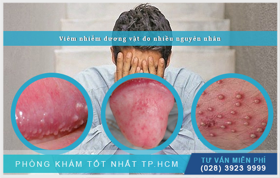 [TP.HCM] Viêm nhiễm dương vật: Nguyên nhân, triệu chứng chi tiết