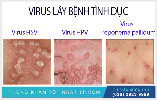 Virus thủy đậu có nguy hiểm không Virus-thuy-dau-va-virus-benh-tinh-duc-cai-nao-nguy-hiem-hon2